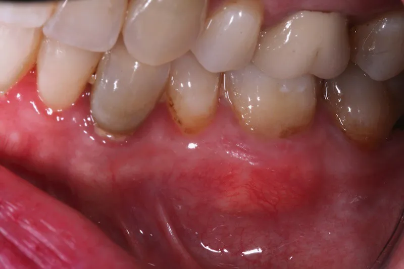 Gum Grafting after procedure