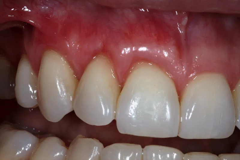 Gum Grafting after procedure