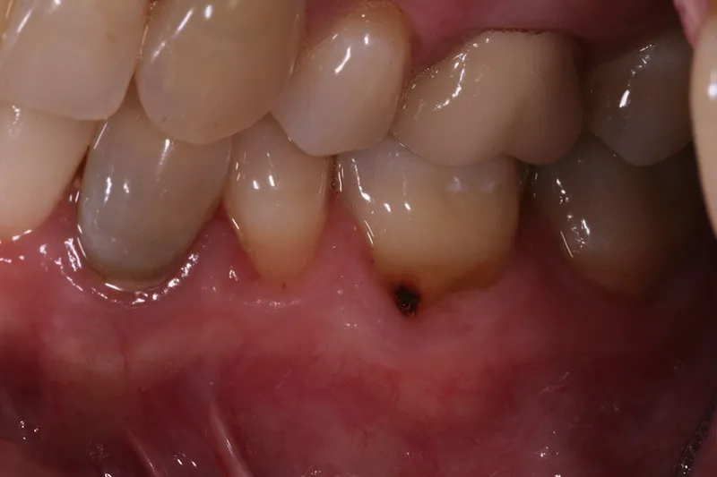 Gum Grafting before procedure