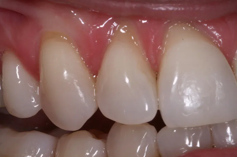 Gum Grafting before procedure