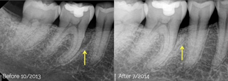 Before/After Lanap FAQ Photo